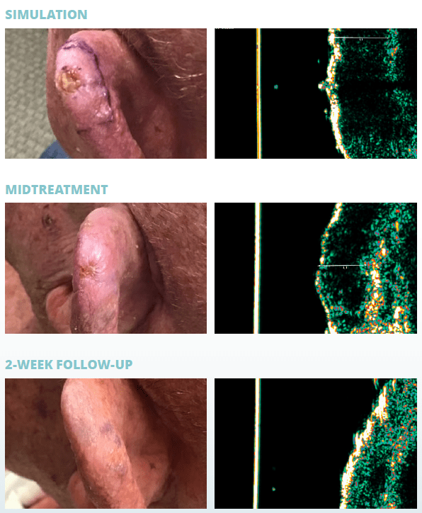 skin cancer treatment progress