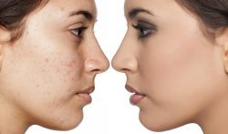 woman with acne looking at woman with beautiful skin