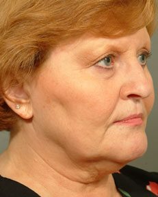 face of a woman before having a facelift
