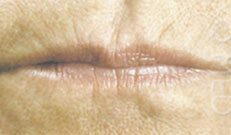 wrinkled lips