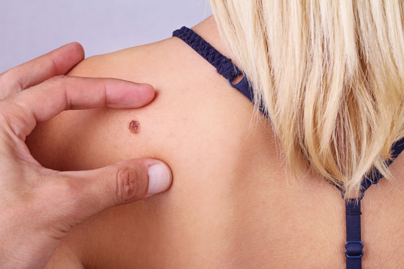 mole on shoulder skin cancer screening