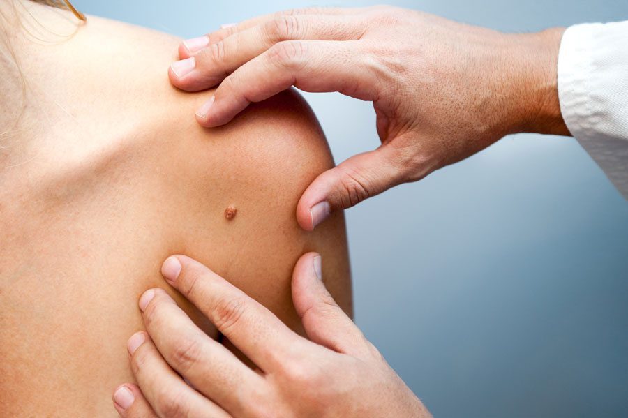doctor examining mole on woman's arm