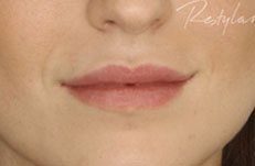 after lip filler photo