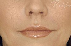 after lip filler photo