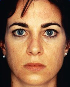 before facial peel photo
