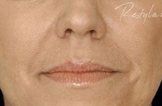 before lip filler photo