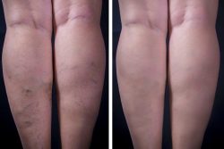 leg vein treatment removal