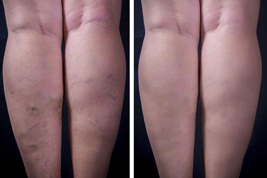 leg vein treatment removal